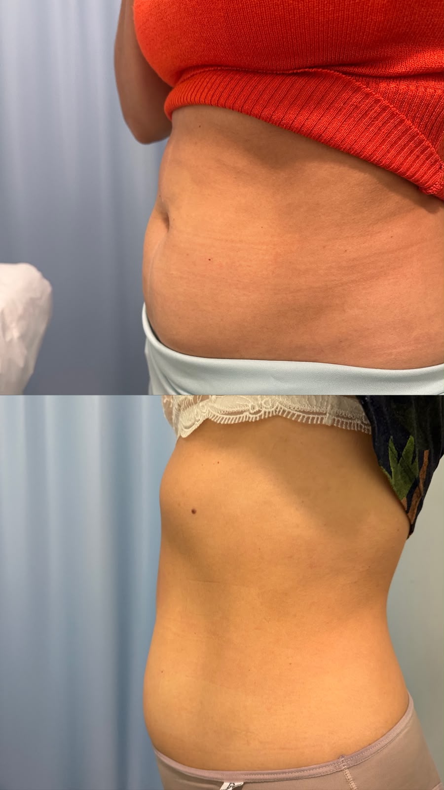 Antes e Depois Diástase - Dra Ana Tereza