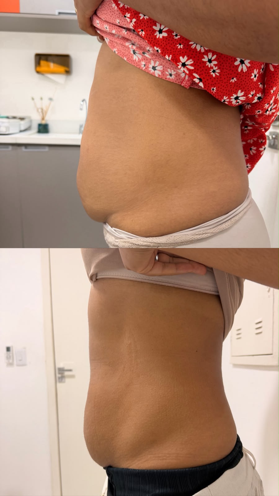 Antes e Depois Diástase - Dra Ana Tereza
